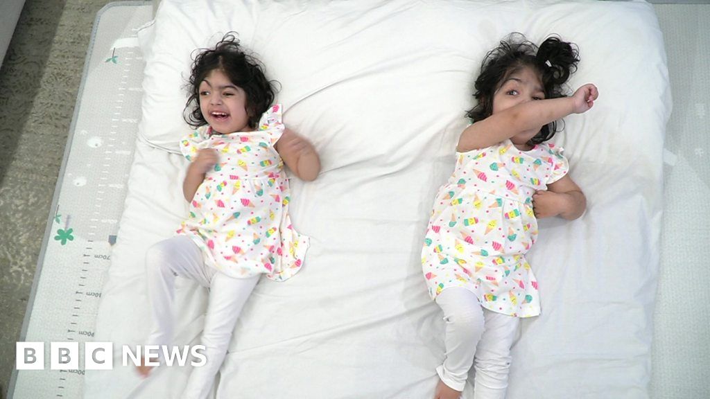 Conjoined Twins Joined At Head Return Home After Successful Surgery