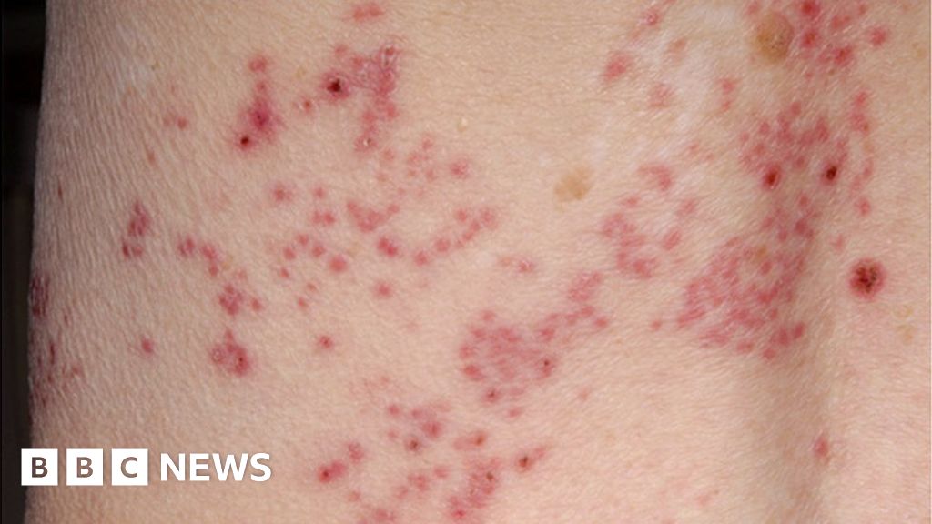 shingles-vaccine-has-cut-cases-by-a-third-in-england-bbc-news