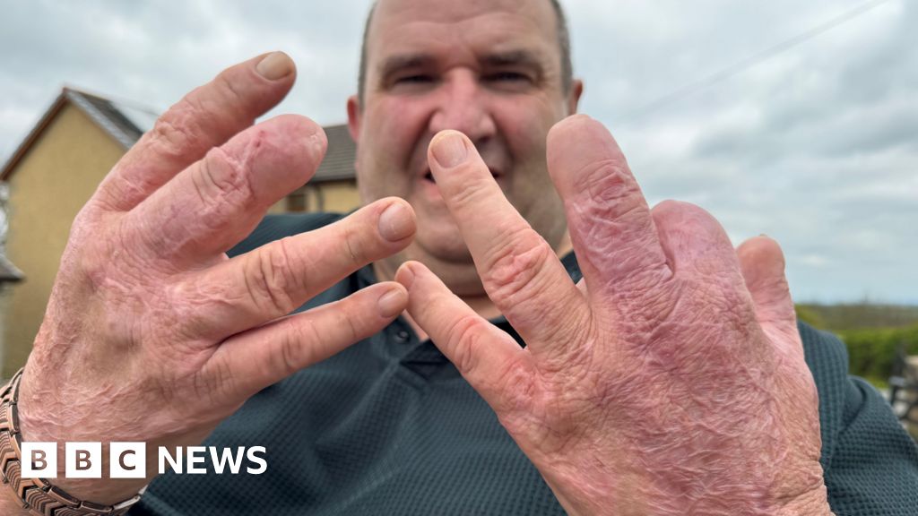 'I was given a choice - keep my legs or keep my life' - the sepsis patient who lived