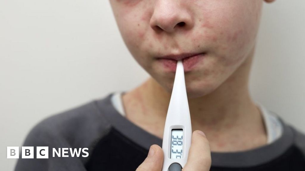 Why are measles cases rising and what is the MMR vaccine?