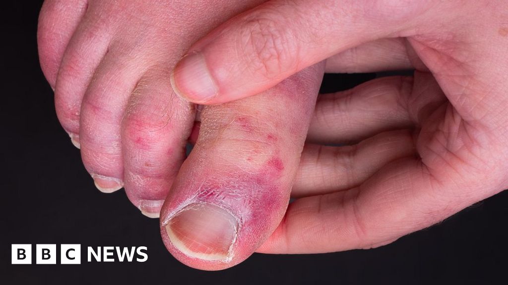 Study Reveals Why Some People Get Covid Toe Condition    120820673 Gettyimages 1250715080 