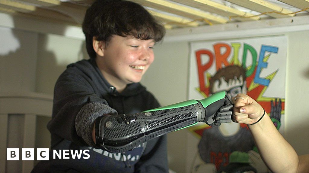 Bionic Hand Gives New Hope to People with Arm Amputations