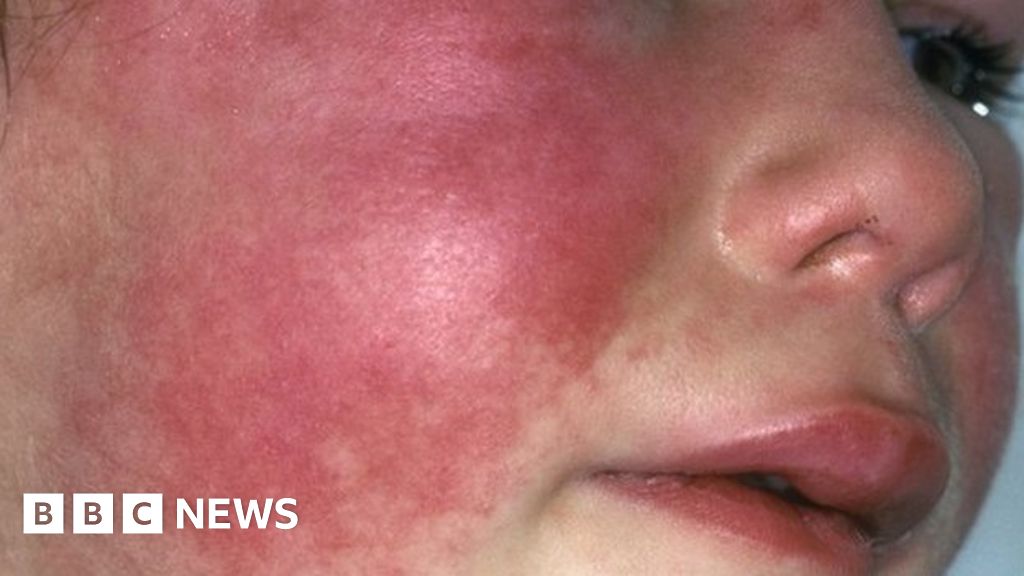 Scarlet Fever: A Deadly History and How it Prevails