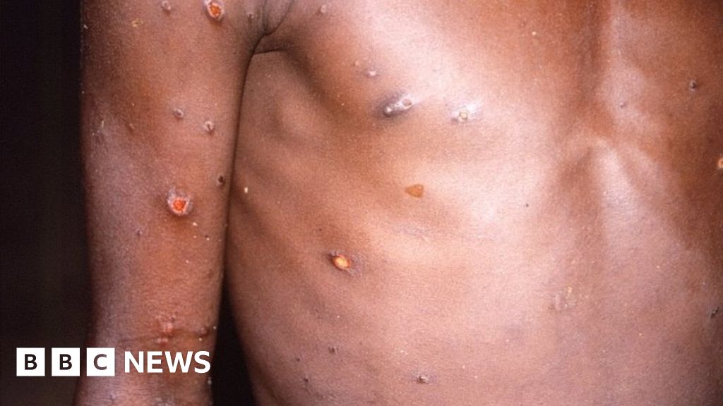 Monkeypox: 80 cases confirmed in 11 countries, says WHO