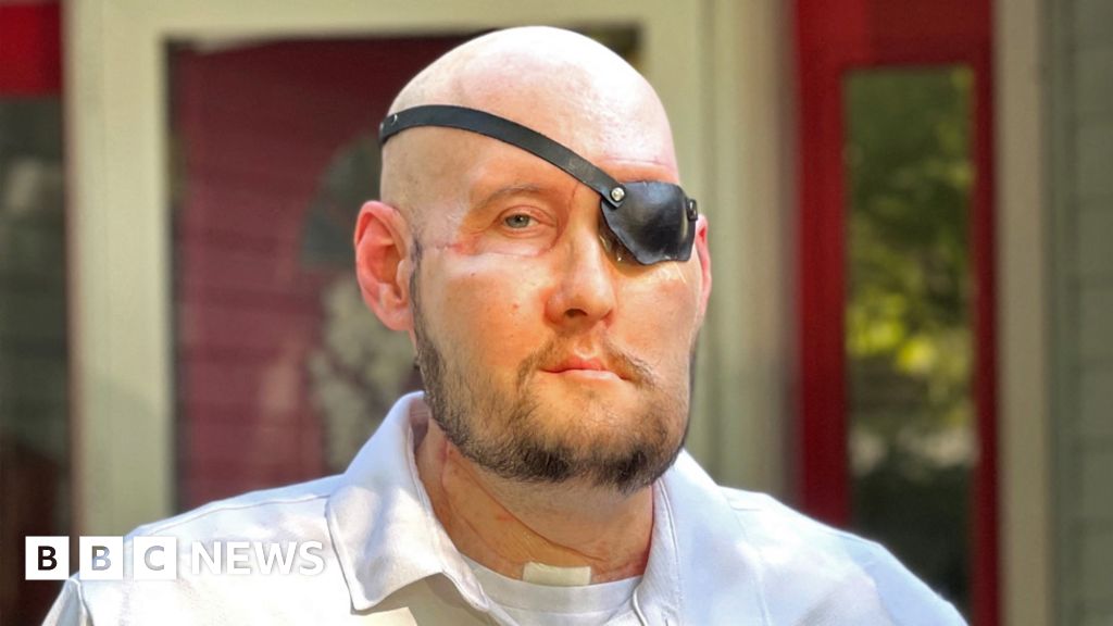 US veteran gets world's first eye transplant - BBC News