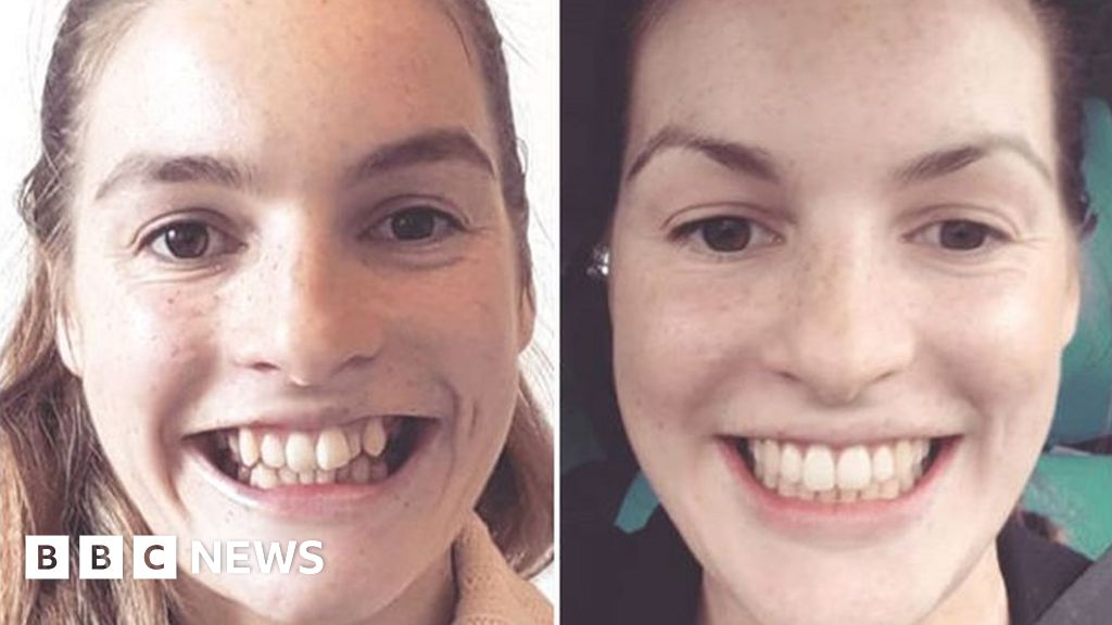 Celebrities with Braces Before and After