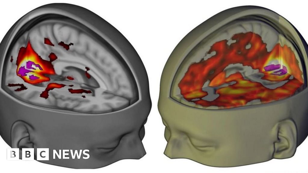 What LSD does to your brain - BBC News