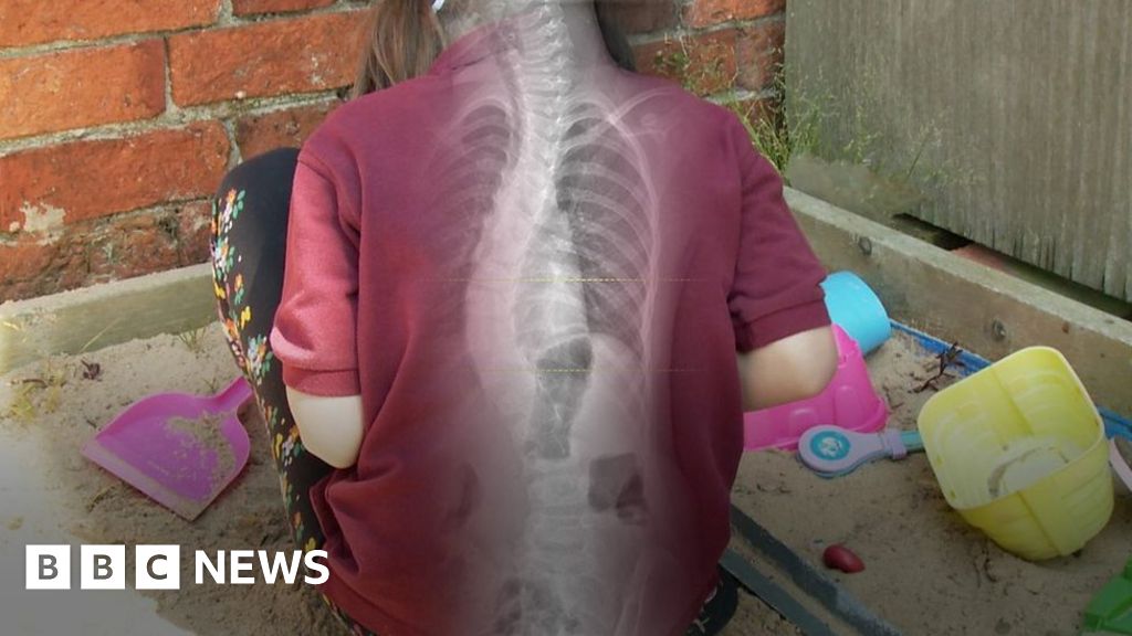 Child scoliosis patient Aleisha given radical surgery - BBC News