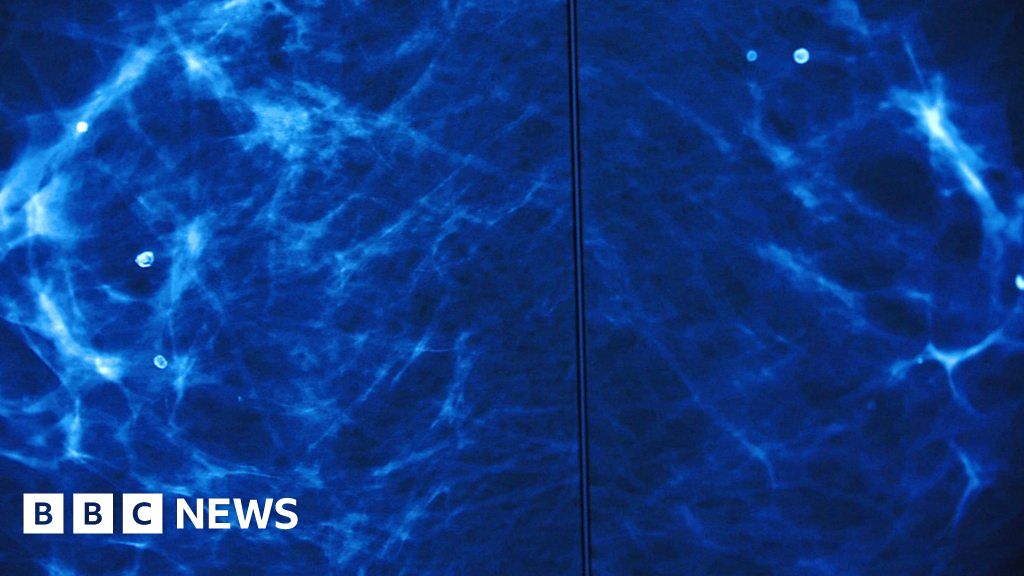 Breast cancer: The AI tool trained to spot the disease