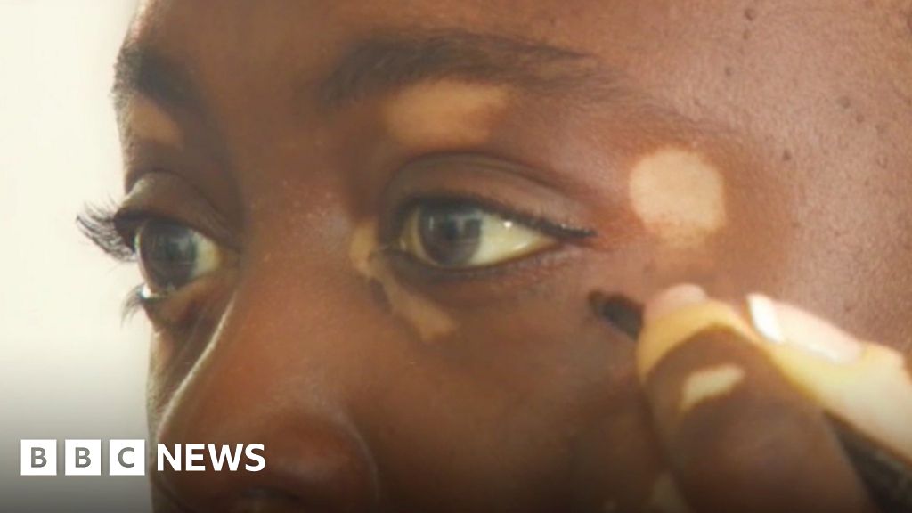 Mother out' as having vitiligo BBC News