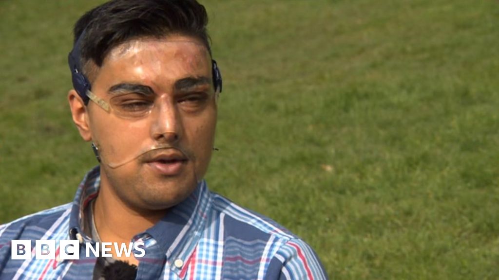 Acid Victim Samir Hussain Relives Attack Every Day Bbc News