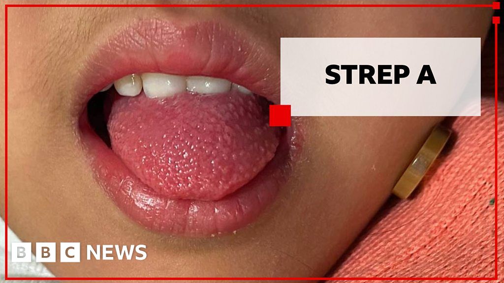 Strep A symptoms: What you need to know, in a minute