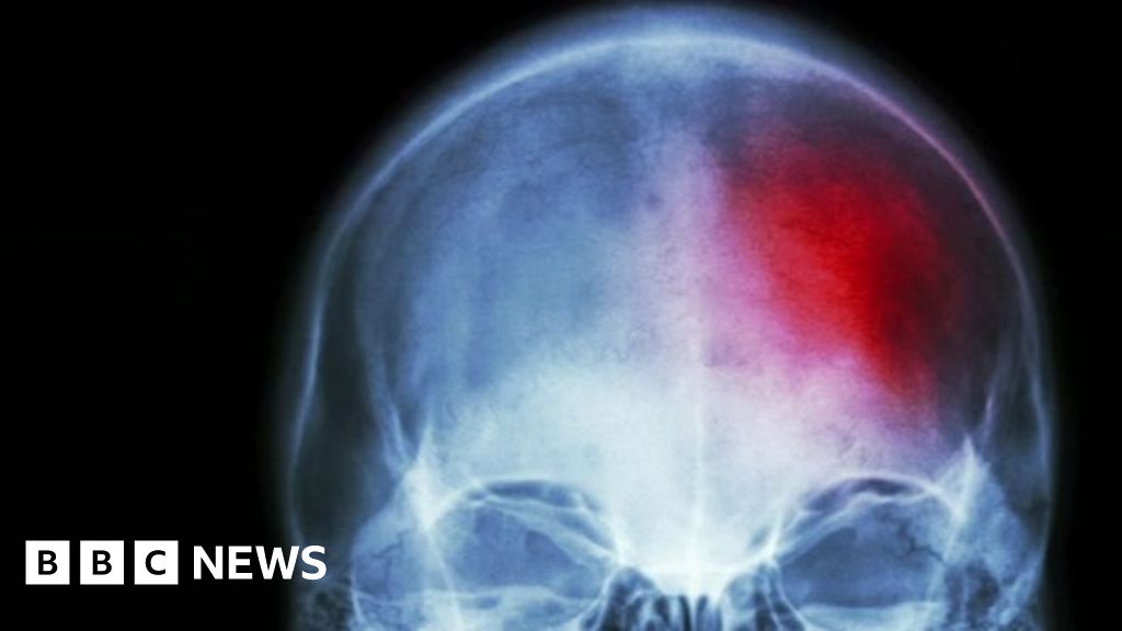 take-aspirin-immediately-after-a-minor-stroke-say-researchers-bbc-news