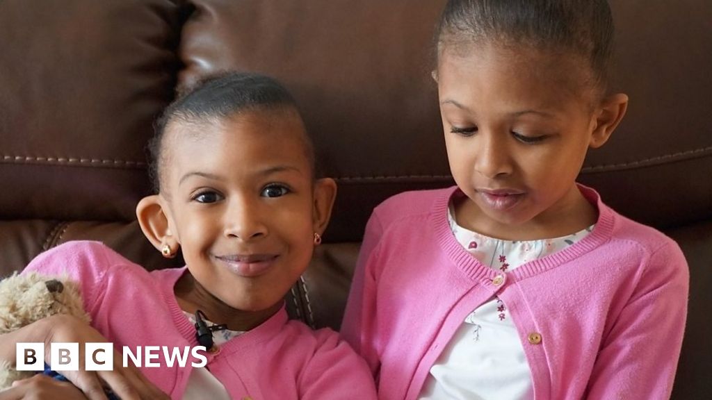 Conjoined Twins Meet Surgeons Who Separated Them Dailyonews