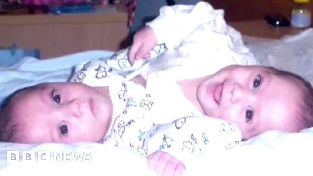 Twins separated by surgeons meet up at hospital party