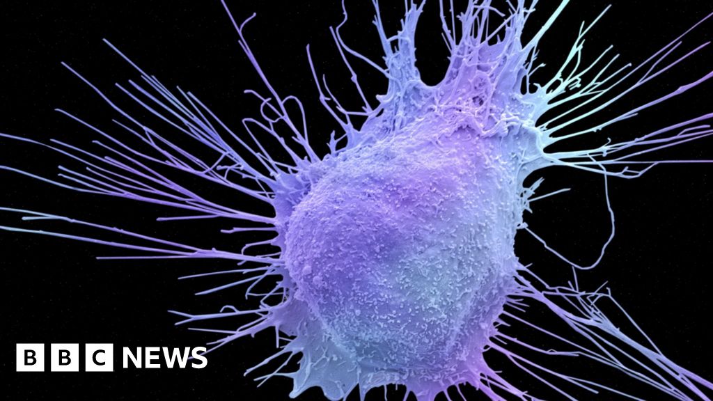 Milestone Prostate Cancer Drug Bbc News 4549