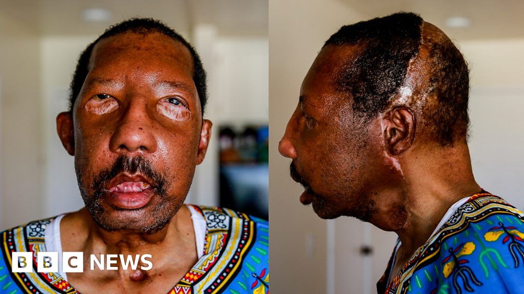 Meet the First African-American Face Transplant Recipient