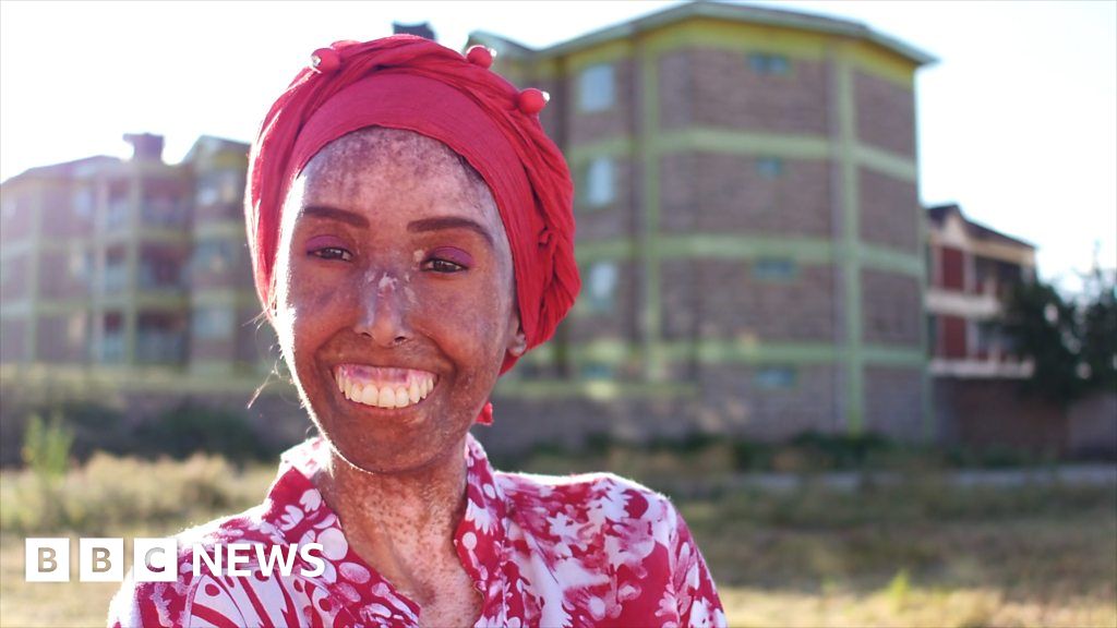 Scleroderma: 'I dey fear to look mirror say fine girl like me don turn to  anoda thing' - BBC News Pidgin