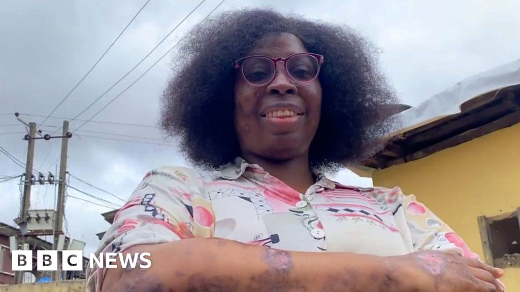 Lupus The disease with a thousand faces BBC News