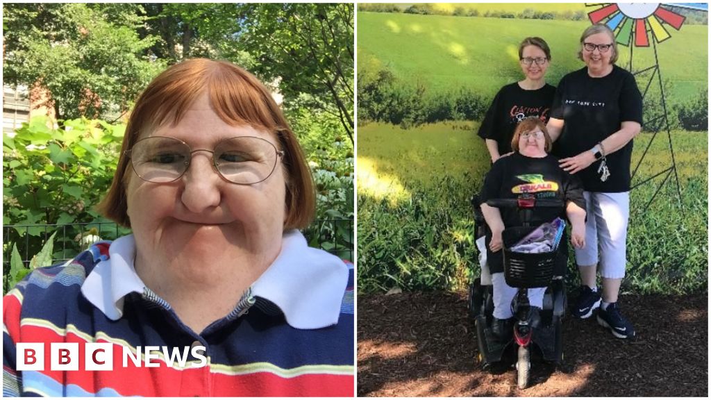 Disability Blogger Trolls Said I Was Too Ugly For Selfies So I Hit 