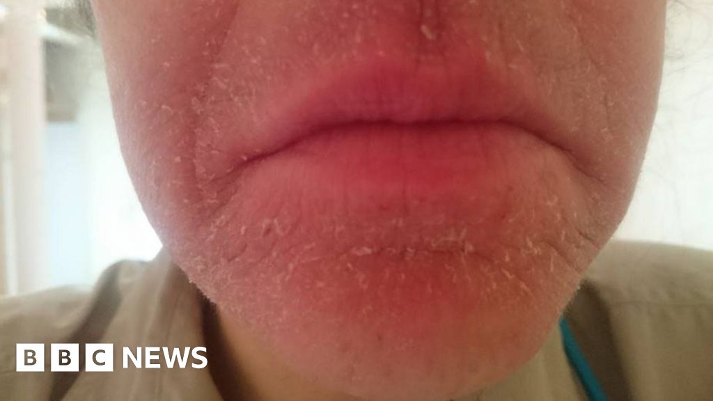 i m allergic to water bbc news