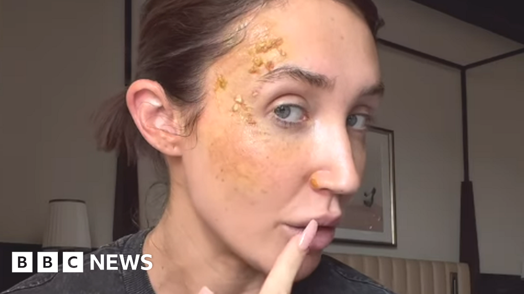 Towie star Megan McKenna reveals burns caused by scalding gravy