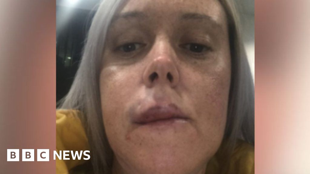 'My lip filler treatment went badly wrong' BBC News