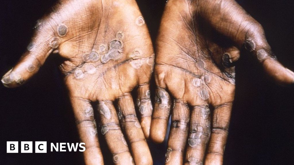 Monkeypox virus outbreaks are containable – WHO