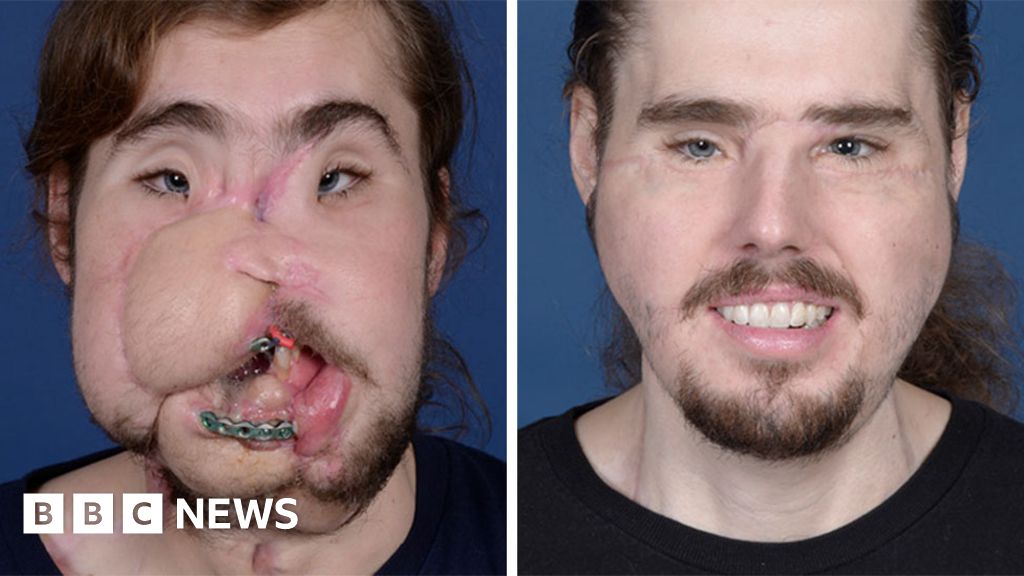 Man who shot himself in face reveals incredible transformation after  transplant - Daily Record