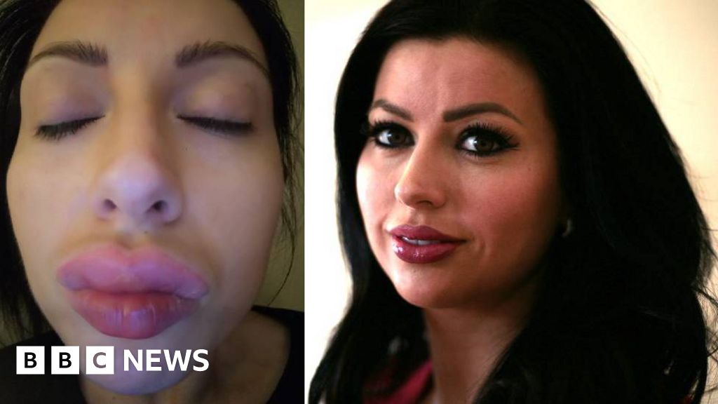 Lip fillers 'Perfect storm' due to lack of regulation BBC News