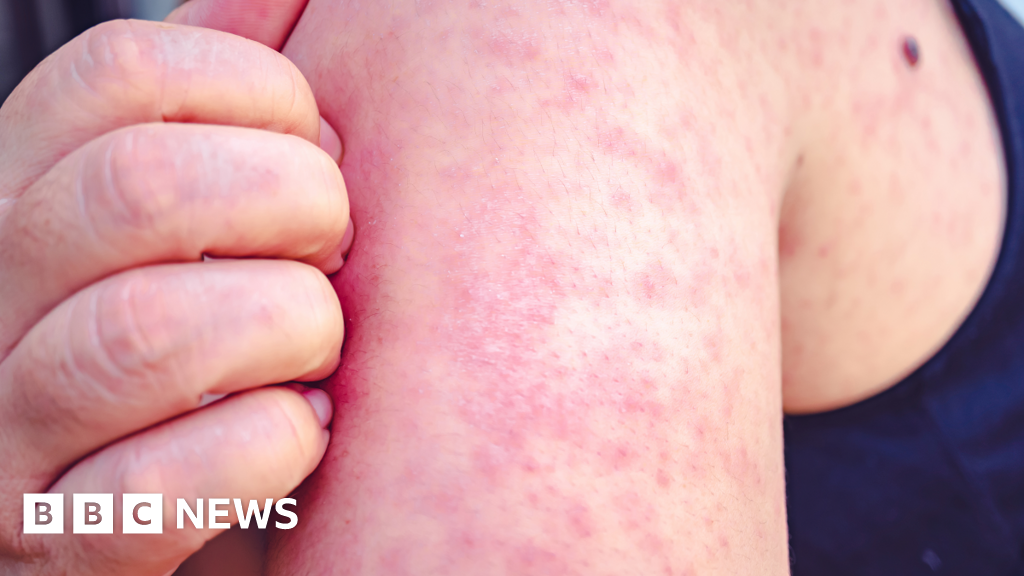 Ireland measles: Adult dies in hospital after contracting disease