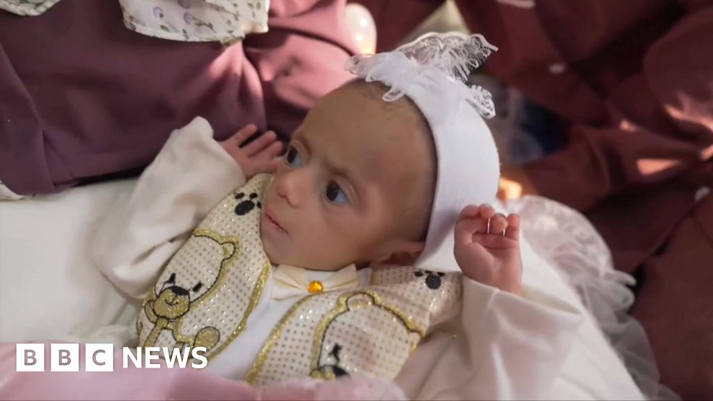 A frail cry and relief: Malnourished baby Siwar evacuated from Gaza