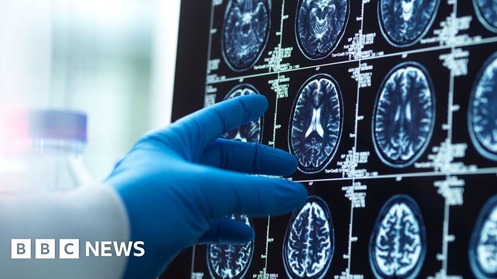 Dementia diagnosis revolutionised by AI and new blood tests - BBC