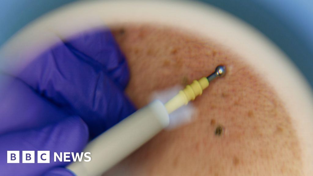 bbc.co.uk - Patrick Barlow - Death of Surrey man prompts skin cancer healthcare concerns