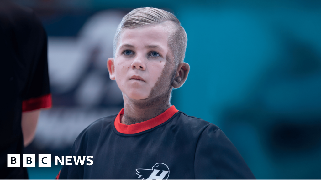 bbc.co.uk - Fiona Callow - CMN birthmark no barrier for young footballing TV star