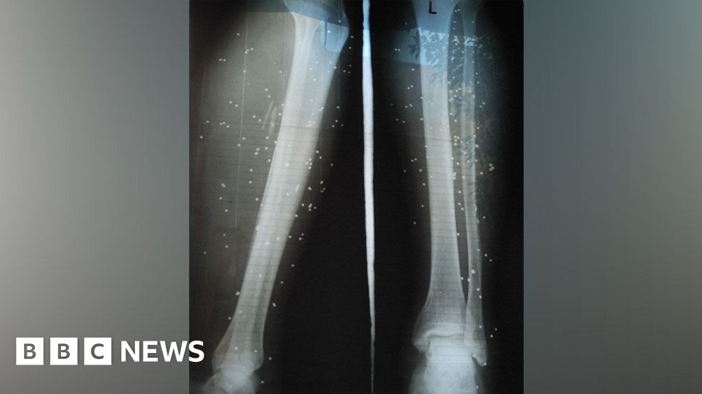 „Не ни карайте в болница“: Протестиращите в Иран се лекуват тайно, за да избегнат арест