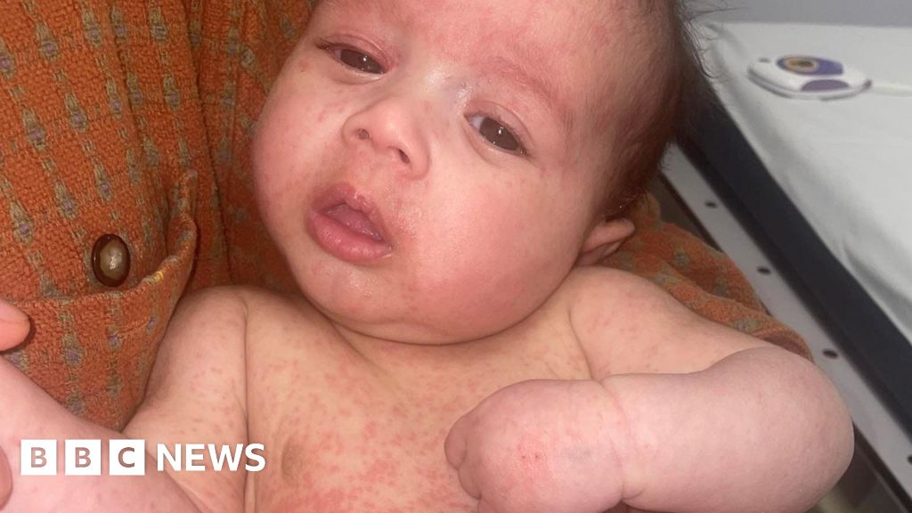 Parents are warned of a rise in measles cases at the start of school