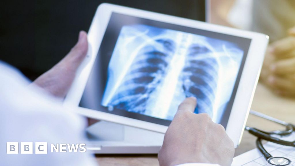 Harrow records highest rate of TB in London