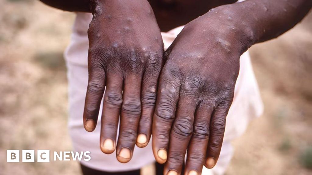 First case of more spreadable mpox detected in UK