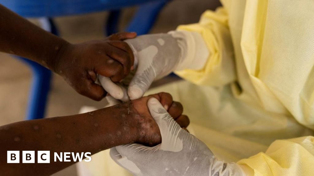 Sweden announces first case of more contagious mpox found outside Africa