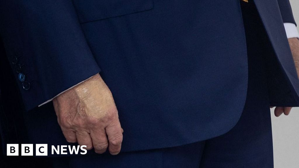 White House says Trump diagnosed with vein condition after questions about bruises