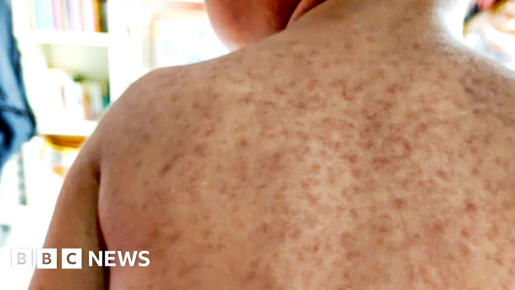 Measles outbreak could see unvaccinated pupils excluded from schools in north London