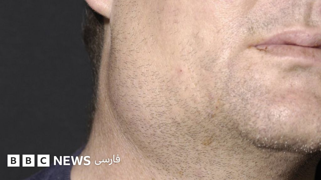 شیوع بی‌سابقه بیماری اوریون و سرخک در انگلستان BBC News فارسی