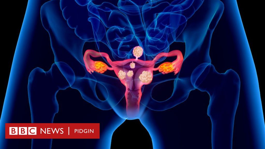 Fibroid: Eight shocking tins wey fit make woman to get dis tumour for ...