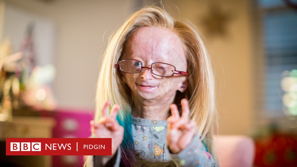 adults with progeria
