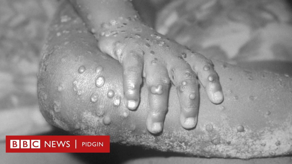 Wetin you suppose know about monkeypox virus - BBC News Pidgin