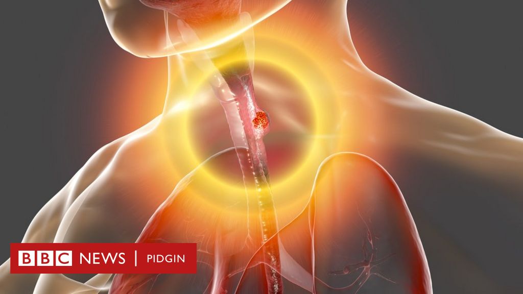 esophagus cancer endoscopy