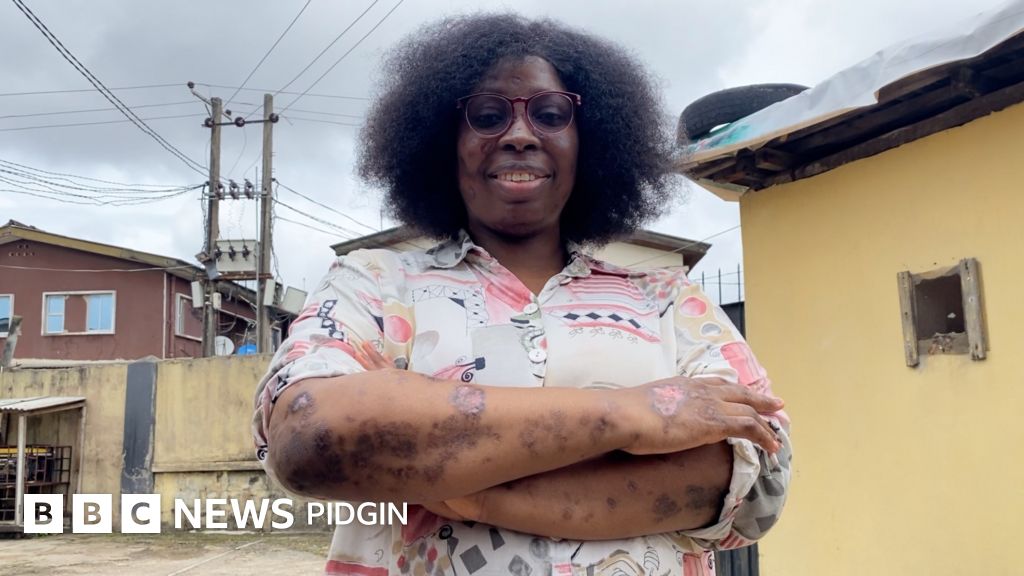 Lupus Di systemic autoimmune disease wit a thousand faces BBC News