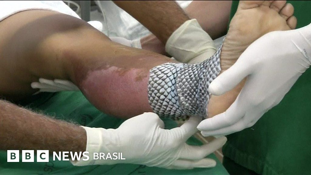 Resultado de imagem para O revolucionário método criado no Brasil para tratar queimaduras graves com pele de tilápia.