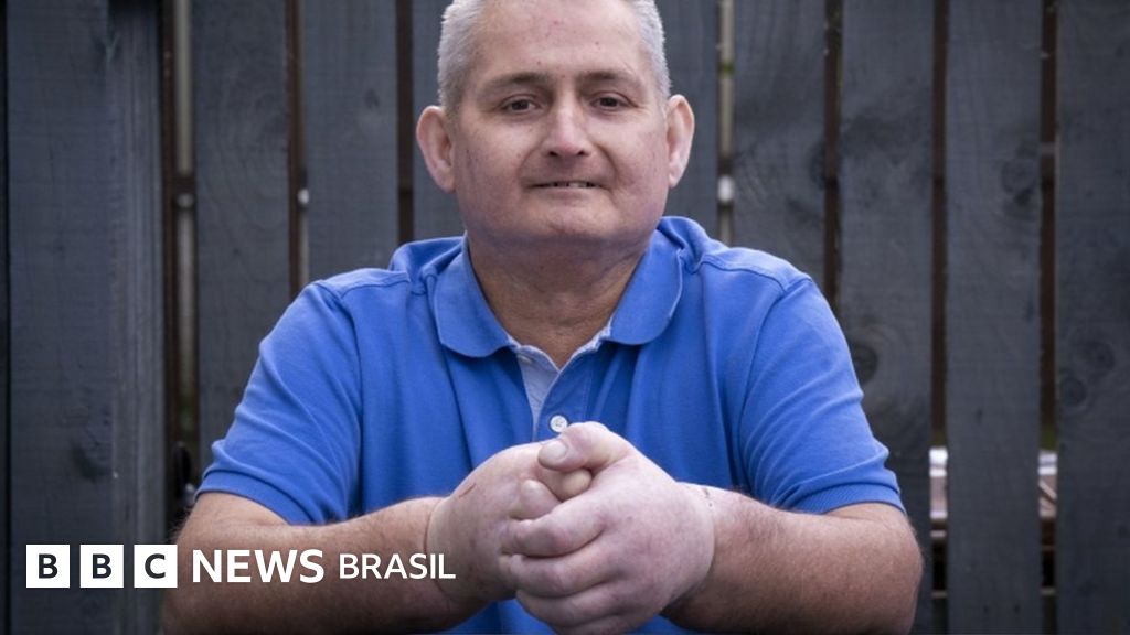 O transplante de mãos que deu ‘nova vida’ a homem com doença rara